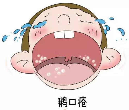 鹅口疮口腔表现