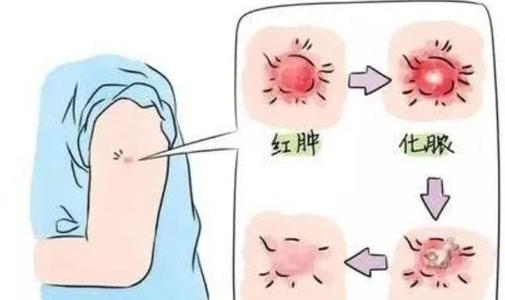 卡介苗接种反应图